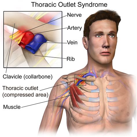 Anatomy of the Thoracic Outlet and the Thoracic Outlet Syndrome