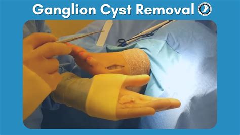 What Is A Ganglion Cyst Ganglion Cyst Removal Without Surgery Images ...