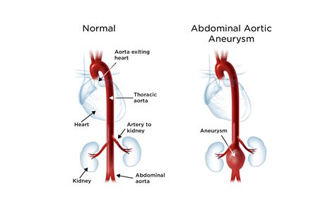 Abdominal Aortic Aneurysm Guide Causes Symptoms And Treatment Options ...