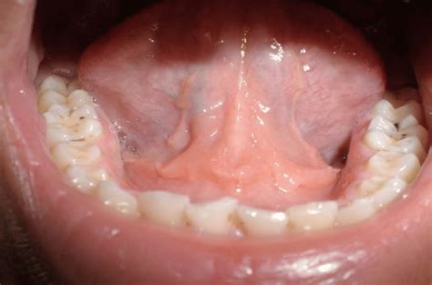 Sublingual swelling developed during the end of initial phase of ...