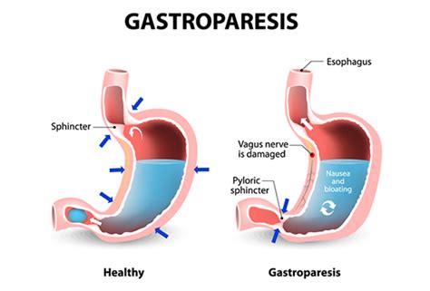 Can Alcohol Cause Gastroparesis? - Recovery Ranger