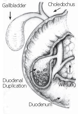 Duodenal duplication cyst causing ... | Medical ultrasound, Cysts ...