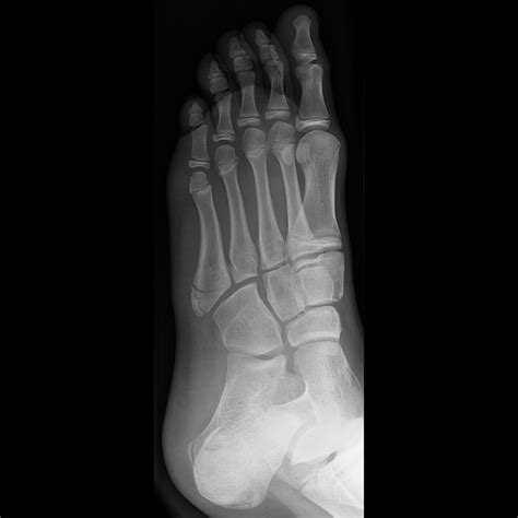 PhysioSolutions: Avulsion Fracture Of The 5th Toe After Ankle Sprain