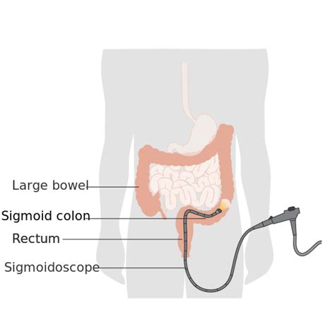 Sigmoidoscopy - Wikipedia