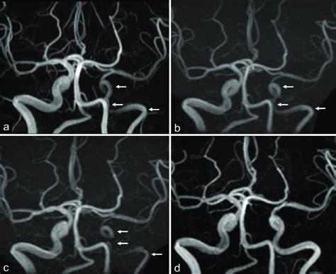 Magnetic resonance angiography (MRA) images of the patient. MRA ...