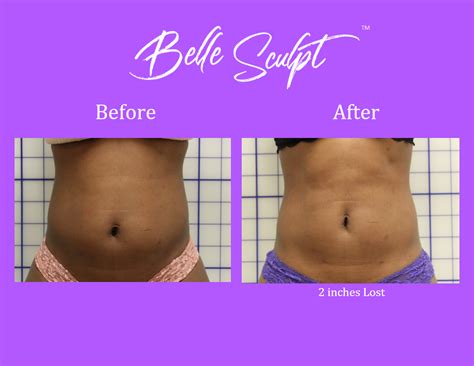 Before & After Sculpt-Stomach 4a - Healthworks