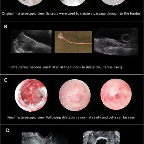 Intrauterine balloon therapy: a novel ultrasound guided treatment for ...