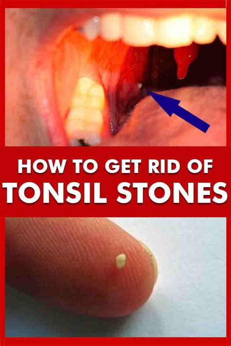 How to Get Rid of Tonsil Stones? Top 10 Home Remedies for Tonsil Stones