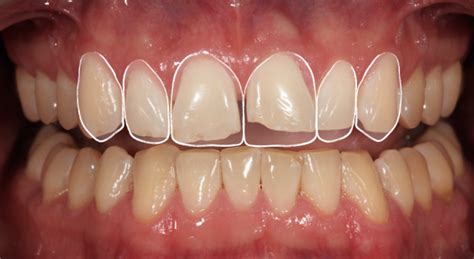 How to Know When You Should Complete a Diagnostic Wax-up - Spear Education