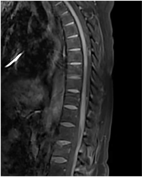 Sagittal section of a thoracic spinal cord MRI showing the anterior ...