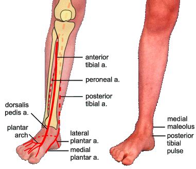 Posterior tibial pulse quality is the most sensitive indicator of ...