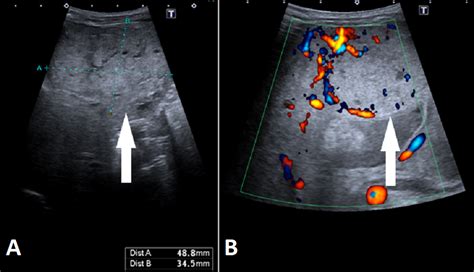 Hepatic Hemangioma Ultrasound