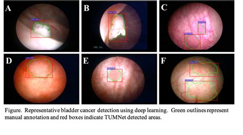 Bladder Cancer Cystoscopy Images / Symptoms Of Bladder Cancer - How To ...