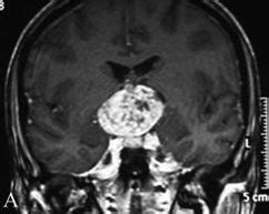 craniopharyngioma | Neurosurgery Blog