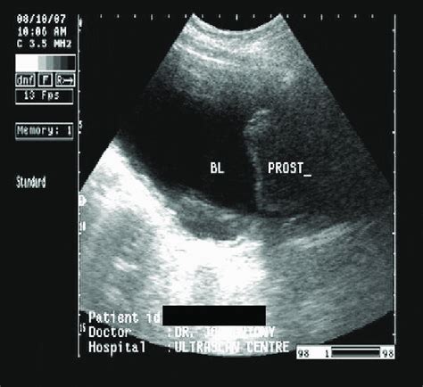 Transabdominal ultrasound scan image reveal intravesical enlargement of ...