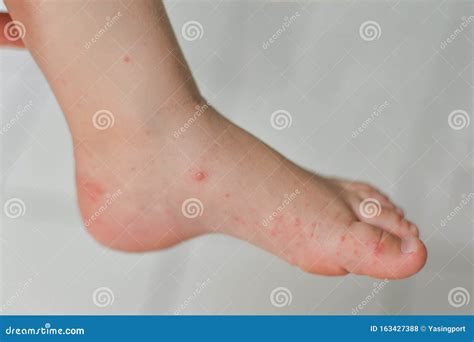 Enterovirus Leg Arm Mouth Rash on the Body of a Child Cocksackie Virus ...