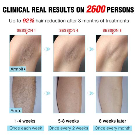 Laser Hair Removal Before And After Arms