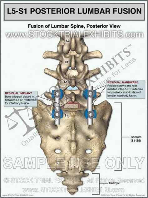 L5-S1 Lumbar Spine Fusion Posterior View | Medical malpractice cases ...