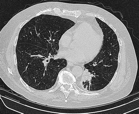 Radiation exposure x ray vs ct - garetnova