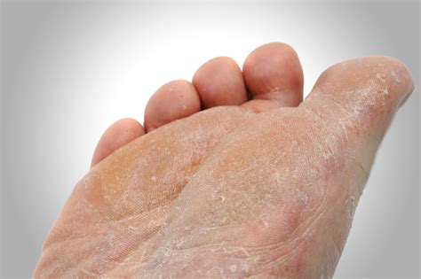 5 Most Common Skin Problems of the Feet