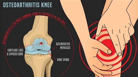 What Is Osteoarthritis? | 1MD Nutrition™