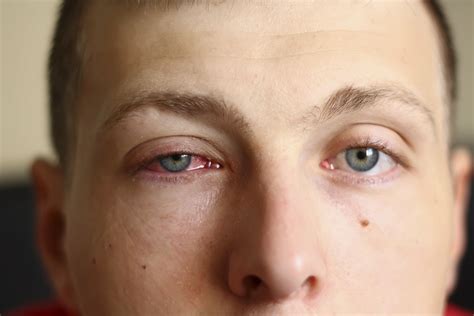 Causes of Swelling Eyelids - Hobart, IN - Deen-Gross Eye Centers