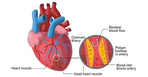 Get an Overview of Heart Attack- CUSABIO