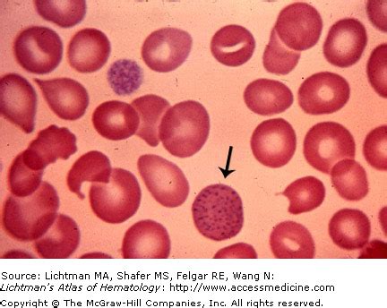 Pathological Red Cell Inclusions | Oncohema Key