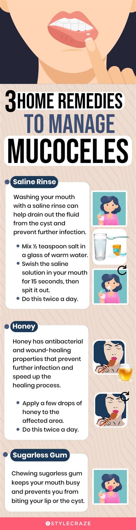 How To Drain A Mucocele Naturally