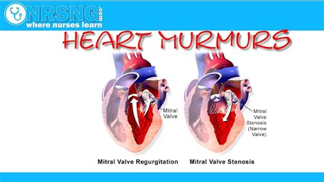 Diastolic Heart Murmurs Are Always Pathologic - Hear Choices