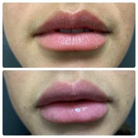 Lip Augmentation Surgery | Risk | Complications | Cost | Before and After