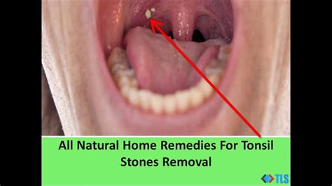 Tonsil Cyst Removal