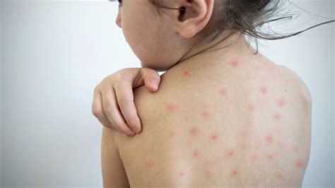 Chicken Pox Treatment Options | Bronx, NYC