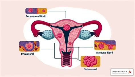 Leiomyoma of the Uterus: Symptoms, Diagnosis, and Treatment Options ...