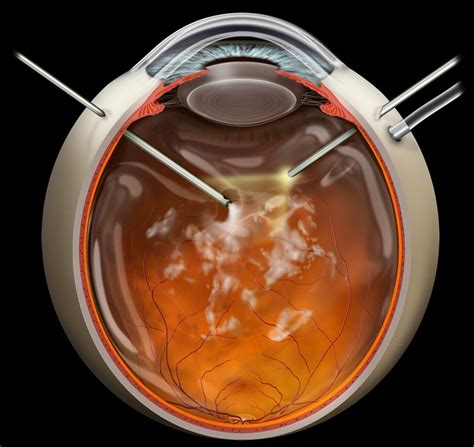 Pars plana vitrectomy interactive - Stock eye images