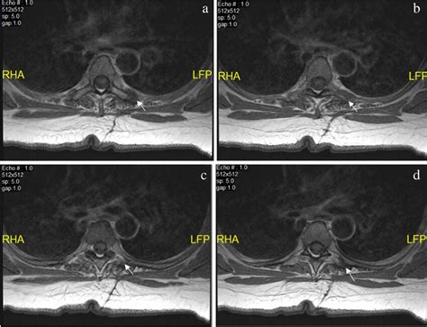 a–d MRI of thoracic spine axial T1 sequential images 1-year status post ...