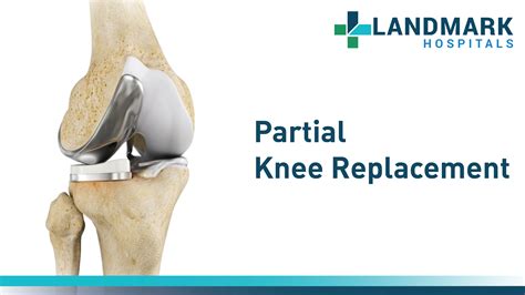 Partial Knee Replacement in Hyderabad By Dr. Sudhir Kumar Reddy ...