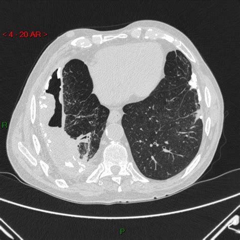 Hydropneumothorax due to tuberculosis | BMJ Case Reports