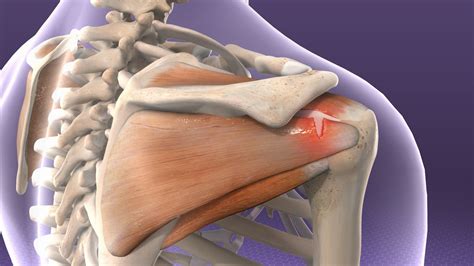 Rotator cuff injury | Physio Fusion Rotator Cuff Injury