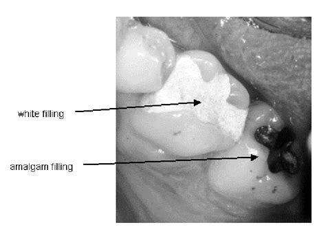 - Glass ionomer cement fillings for teeth. The white, ionomer filling ...