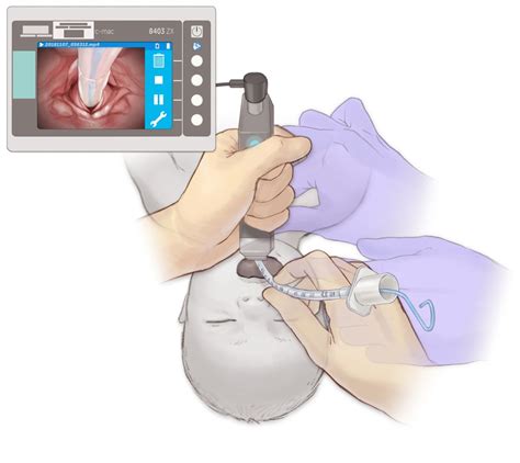 Tracheal intubation – Online supplement