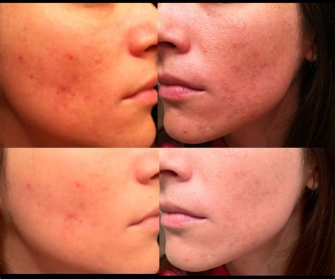 Reviews for Tretinoin to treat Acne