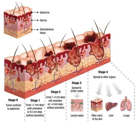 Skin Cancer Stages