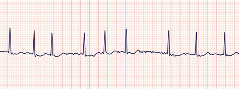 Cardiac rhythm interpretation - Revision Cards in Other Other