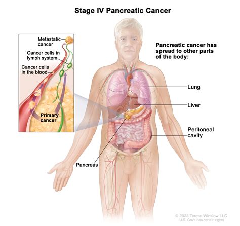 Pancreatic Cancer | UCSF Department of Surgery