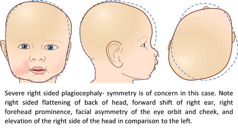 Cranial Remolding - Del Bianco