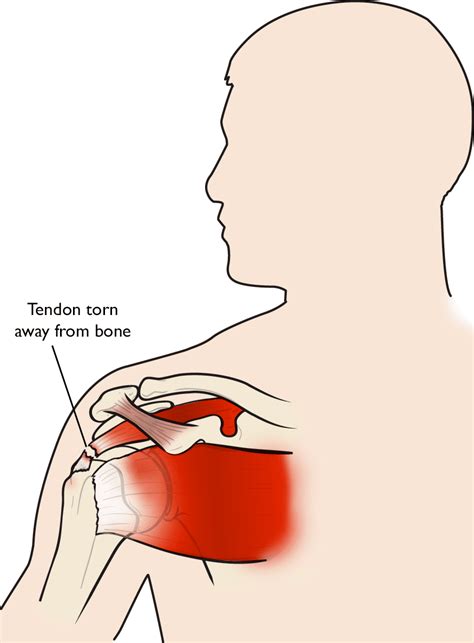 Shoulder/Elbow