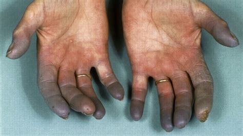 Difference Between Raynaud’s Disease and Buerger’s Disease - YouTube