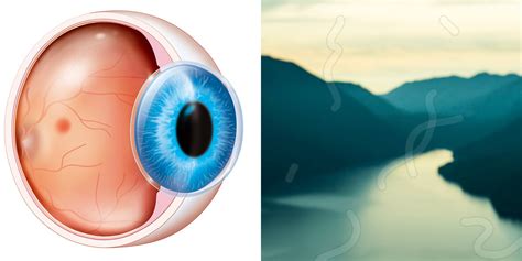 Eye Floaters: Causes And Symptoms | SELF