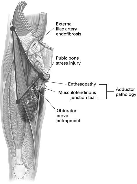 The groin triangle: a patho-anatomical approach to the diagnosis of ...